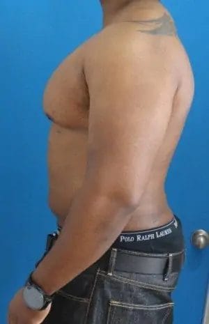 Liposuction Before & After Patient #13988