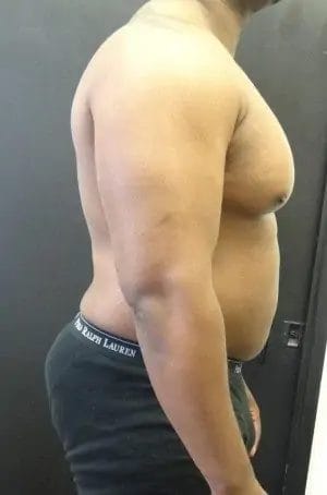 Liposuction Before & After Patient #13988