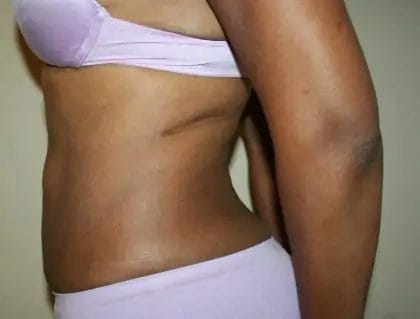 Liposuction Before & After Patient #14538