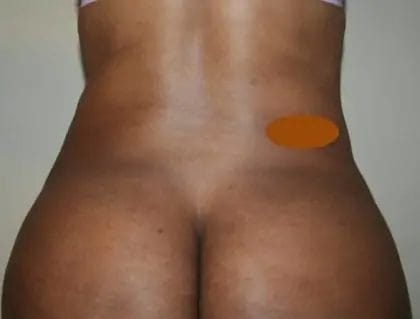 Liposuction Before & After Patient #14538